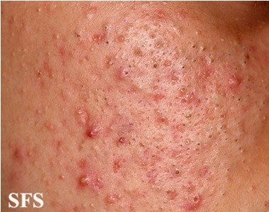 dermatologic disease1