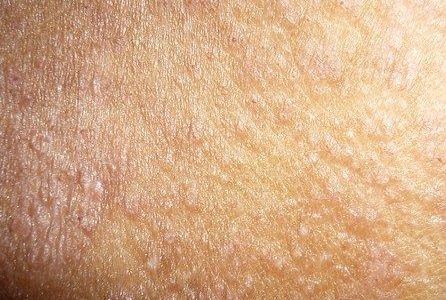 dermatologic disease2