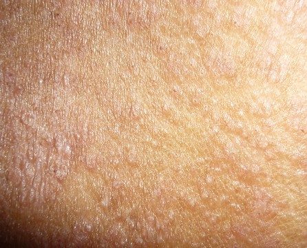 dermatologic disease2